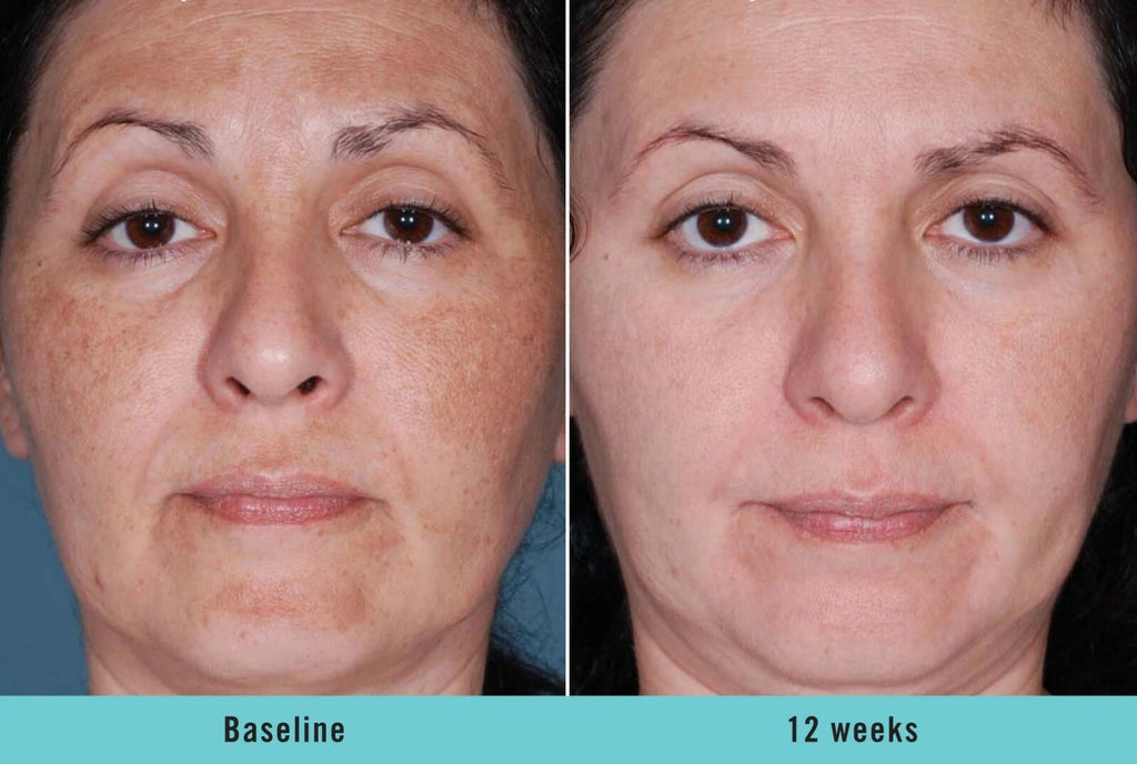 Kojic Acid Brightening Serum – Dark Spot Corrector