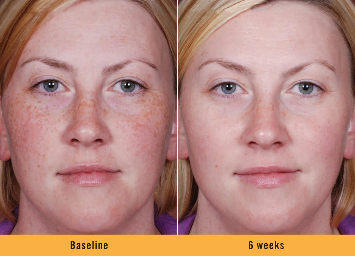 Kojic Acid Brightening Serum – Dark Spot Corrector